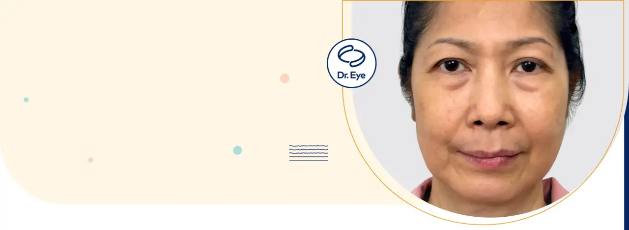 Uneven Eyelids, Monolids, and Hidden Eyelid