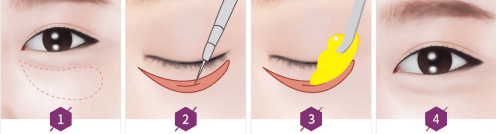 quy trình 7 bước cắt mí mắt dưới