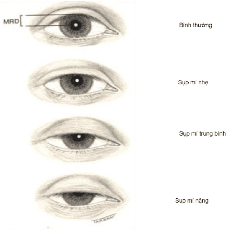 Các mức độ sụp mí mắt dựa theo khoảng cách tâm giác mạc - bờ tự do mi trên MRD.