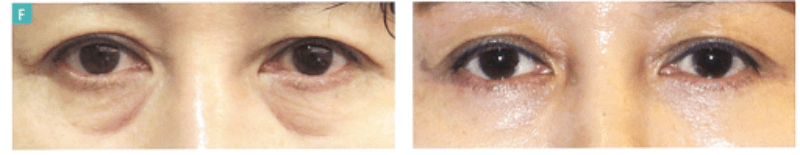Điều trị quầng thâm mắt bằng phẫu thuật cắt mí dưới qua đường rạch ngoài da, giải quyết các dấu hiệu lão hóa ở tuổi trung niên (bao gồm quầng thâm, bọng mỡ, rãnh lệ và da thừa).
