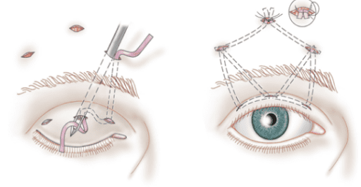 Điều trị sụp mí mắt bằng cách sử dụng dải cân đùi / cân cơ thái dương nông.