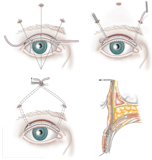Điều trị sụp mí mắt bằng cách sử dụng sợi silicon.
