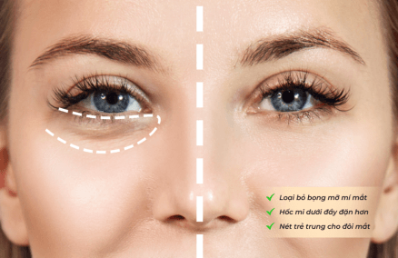 Chống lão hóa mi mắt dưới
