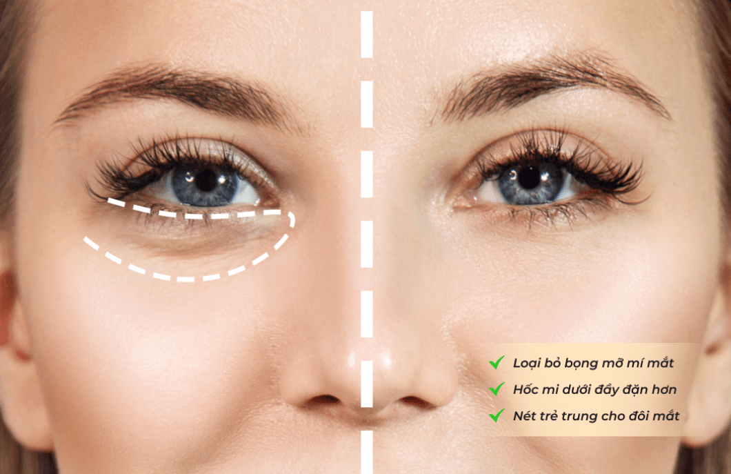 Chống lão hóa mí mắt dưới