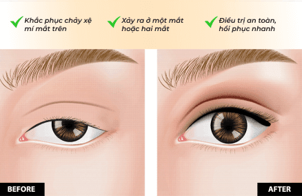 Điều trị sụp mí