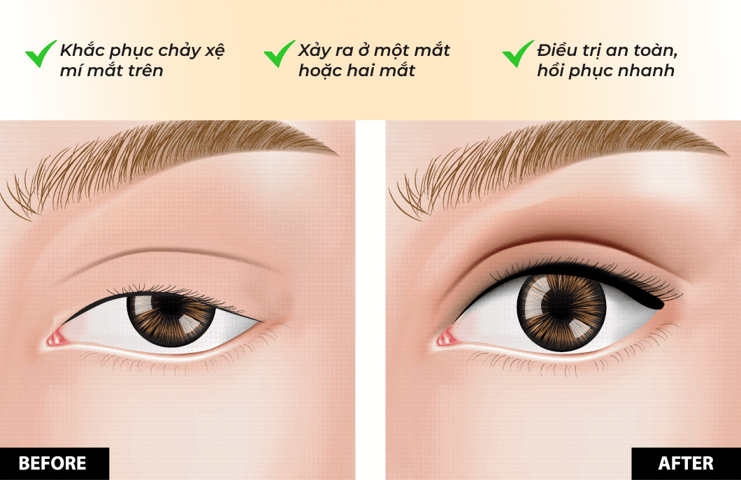 Điều trị sụp mí