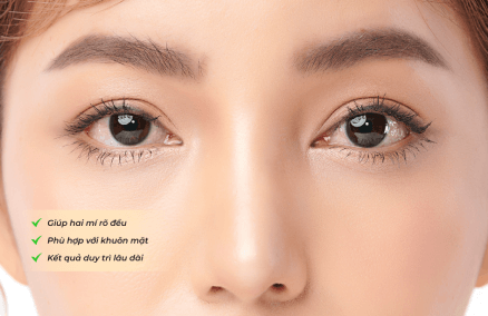 Giải pháp cho mắt 2 mí không đều, mắt 1 mí, mí lót