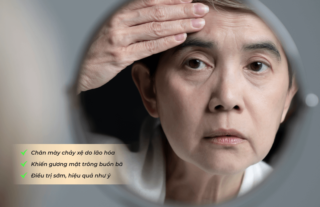 Nâng cung chân mày thấp, chảy xệ
