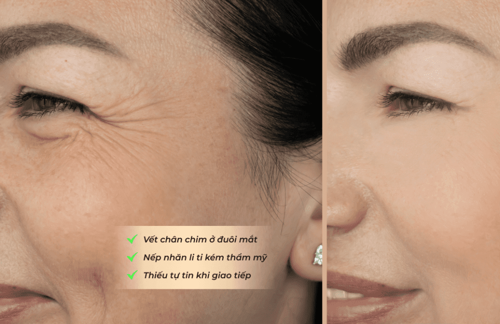 Xóa nếp nhăn quanh vùng mắt