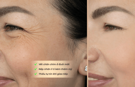 Xóa nếp nhăn quanh vùng mắt