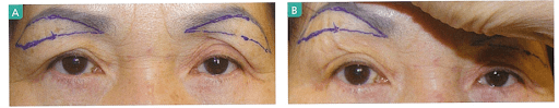 Phẫu thuật nâng cung mày dưới để điều trị chùng nhão da, cải thiện sụp mí mắt.