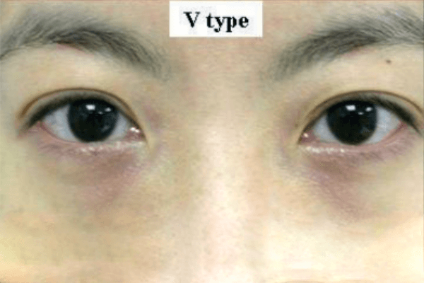 Quầng thâm mắt do mạch máu (Vascular- V)