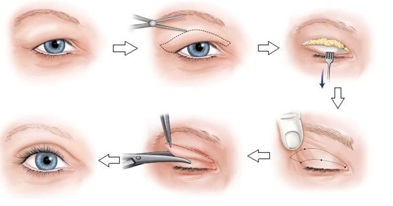 Quy trình các bước cắt mí mắt