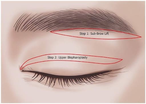 Treo cung mày kết hợp cắt mí giúp đạt hiệu quả toàn diện cả về chức năng lẫn thẩm mỹ cho đôi mắt.