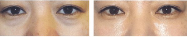 Trước và sau điều trị thâm quầng mắt, bọng mắt qua đường kết mạc.