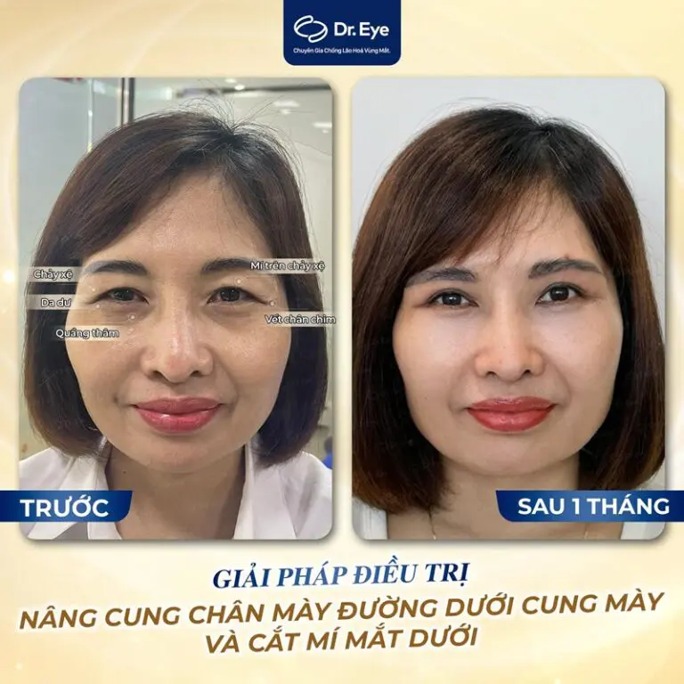 ca điều trị cắt mí dưới