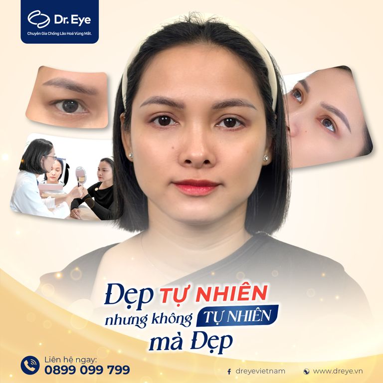 cắt mí được vĩnh viễn không