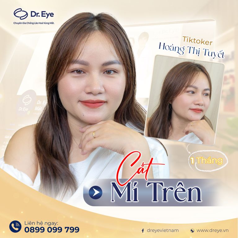 cắt mí mắt được vĩnh viễn không