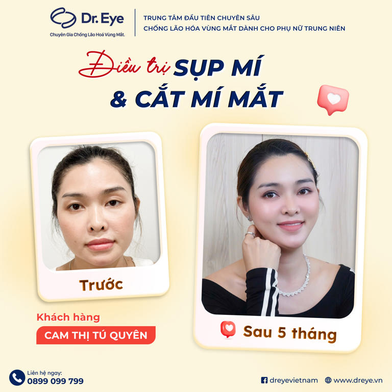 điều trị sụp mí và cắt mí mắt