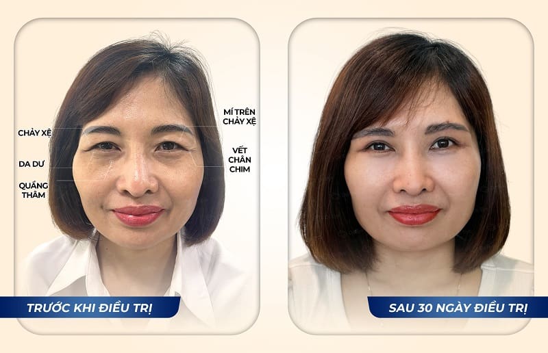 Hình ảnh khách hàng Lê Thị Hoa sau điều trị
