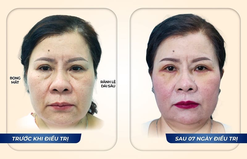 Hình ảnh khách hàng Lê Thị Minh sau điều trị