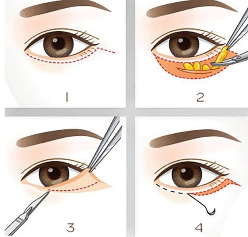 Quy trình cắt mí mắt thừa dưới tại Dr Eye