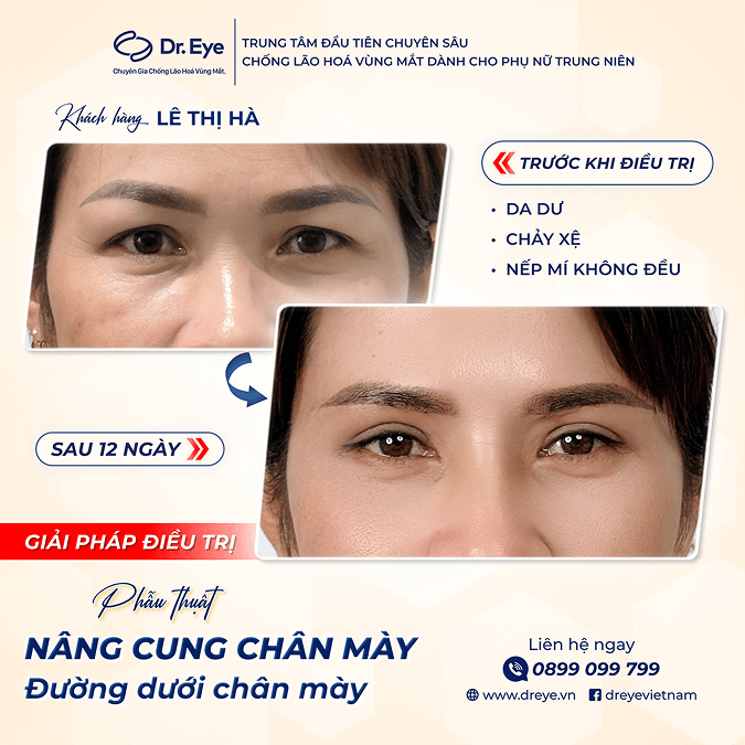 sau khi nâng cung chân mày