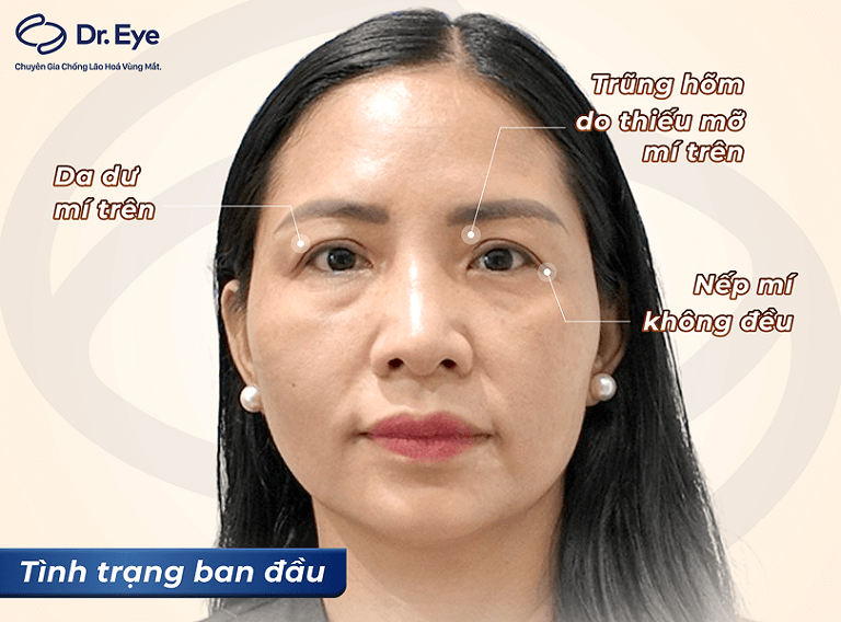 Nâng cung mày bao lâu hết sưng