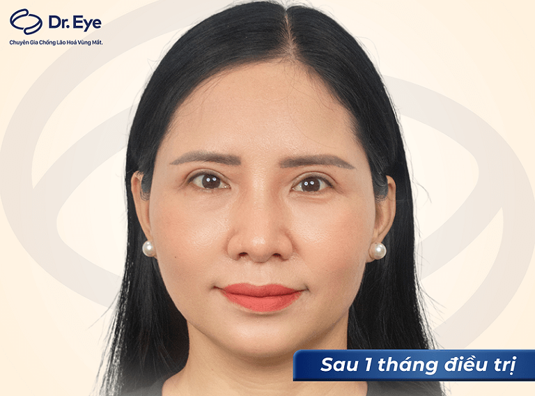 Hình ảnh khách hàng thực hiện treo cung chân mày lành thương sau 1 tháng điều trị