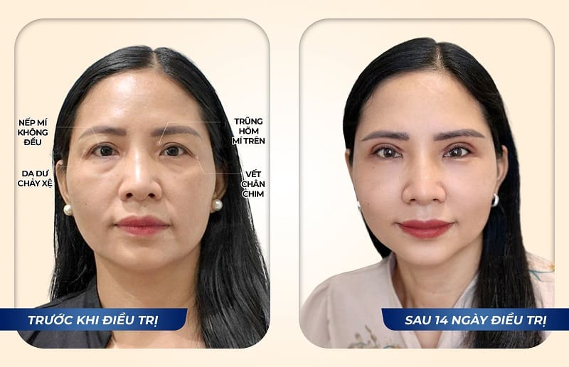 Hình ảnh khách hàng Đào Phương Nhi sau điều trị