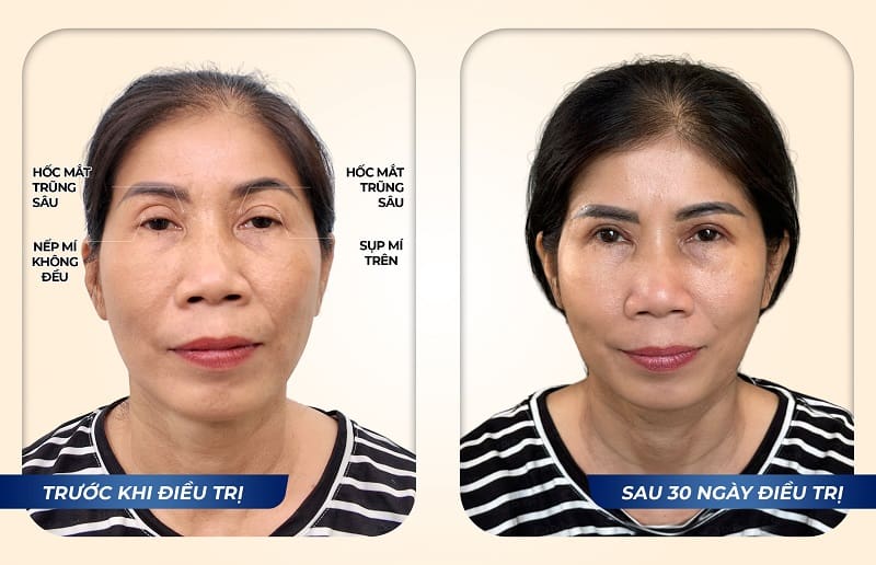 Hình ảnh khách hàng Nguyễn Thị Loan sau điều trị