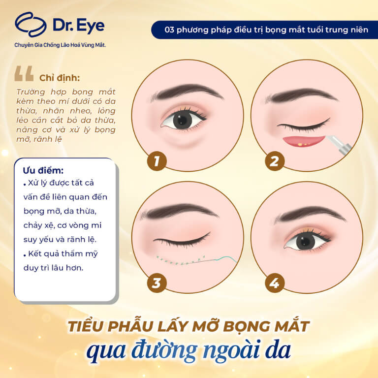 Cắt mí dưới qua đường rạch ngoài da