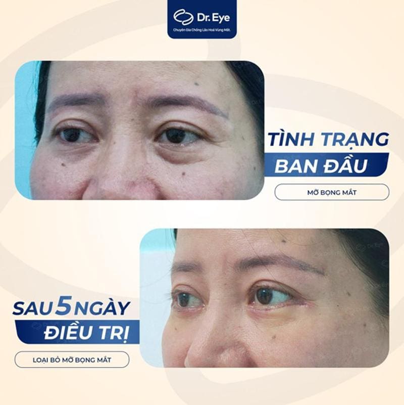 Khách hàng điều trị bọng mắt tại Dr. Eye 2