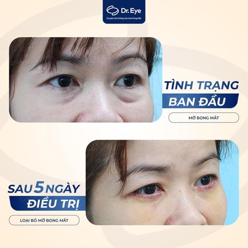 Khách hàng điều trị bọng mắt tại Dr. Eye 3