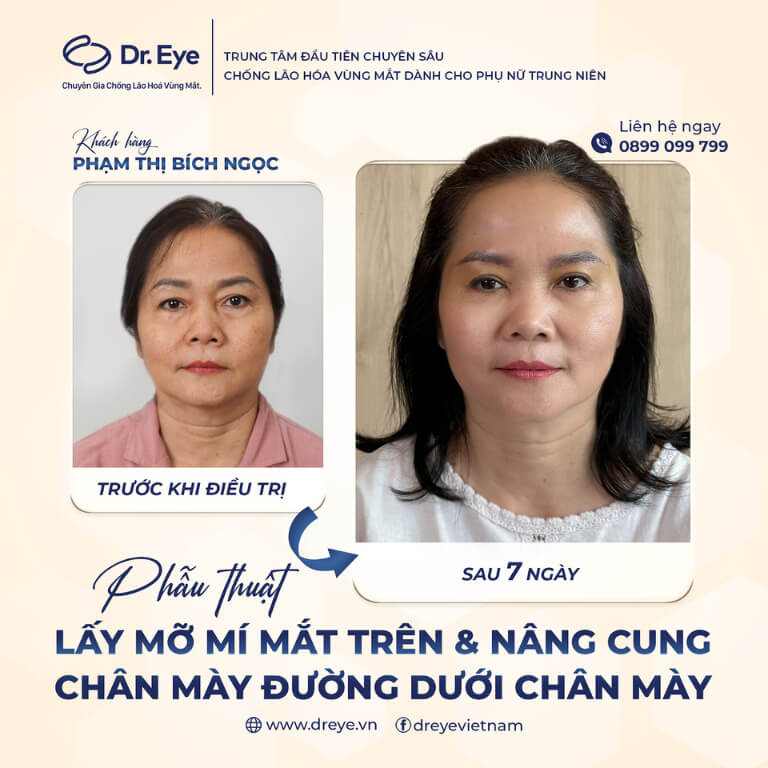 Lấy mỡ mí mắt trên và nâng cung chân mày