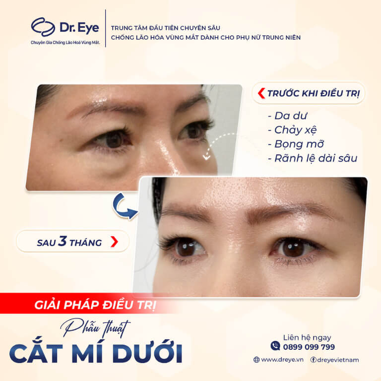 Điều trị bọng mắt dưới tại Dr. Eye 