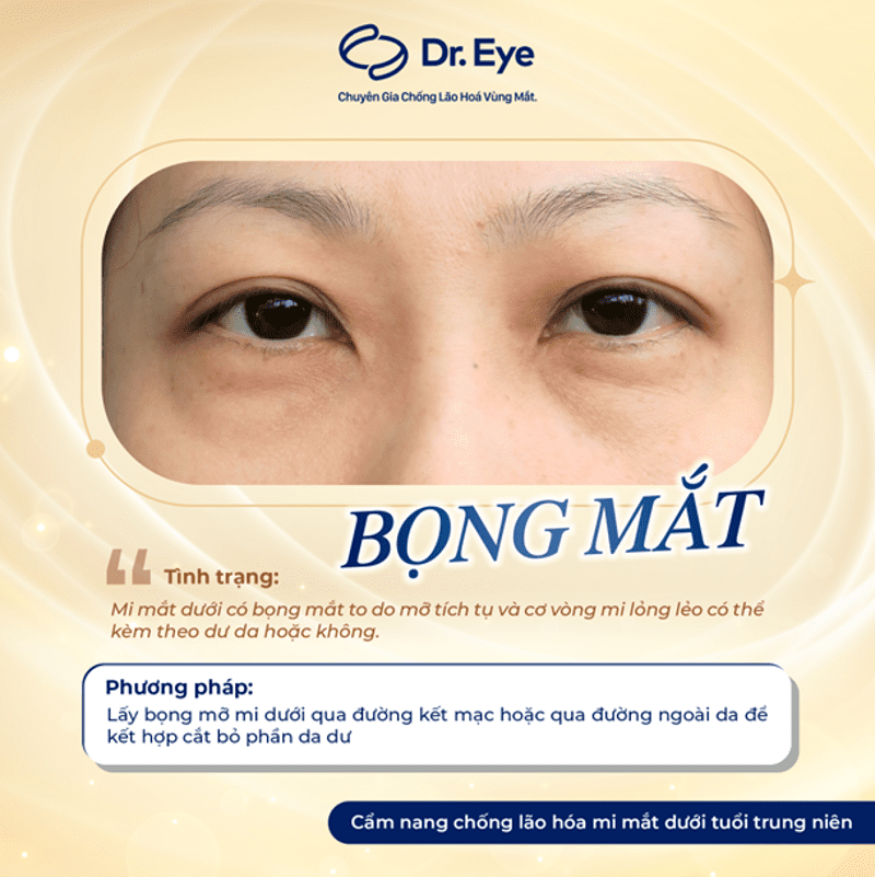 Dịch vụ điều trị bọng mắt tại Dr. Eye