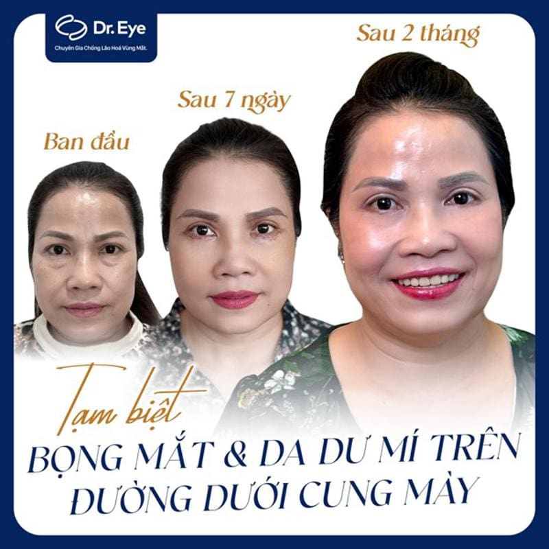 Khách hàng điều trị bọng mắt tại Dr. Eye sau 1 tháng