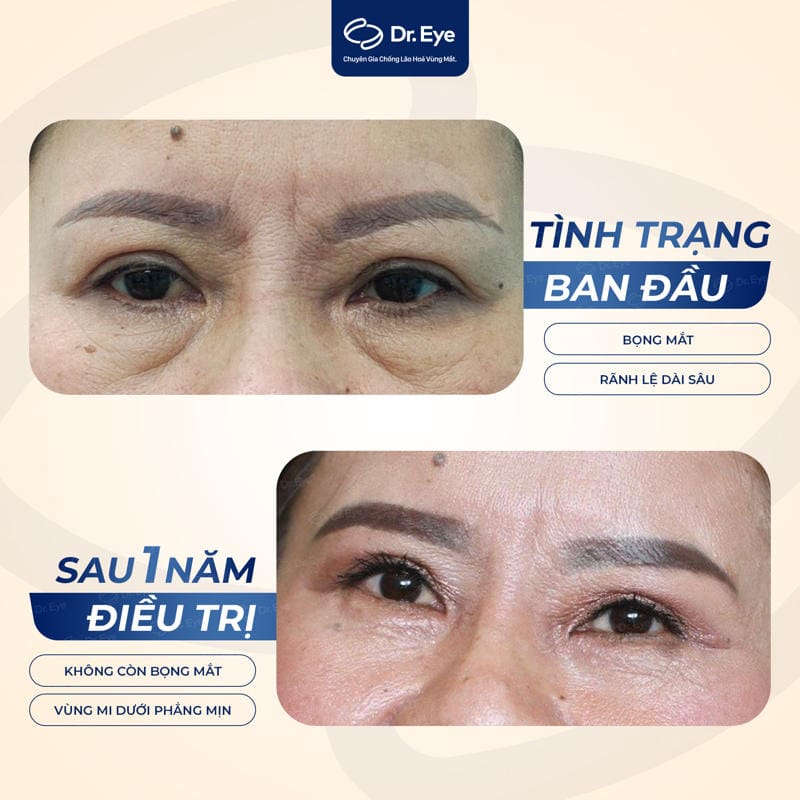 Khách hàng điều trị bọng mắt tại Dr. Eye