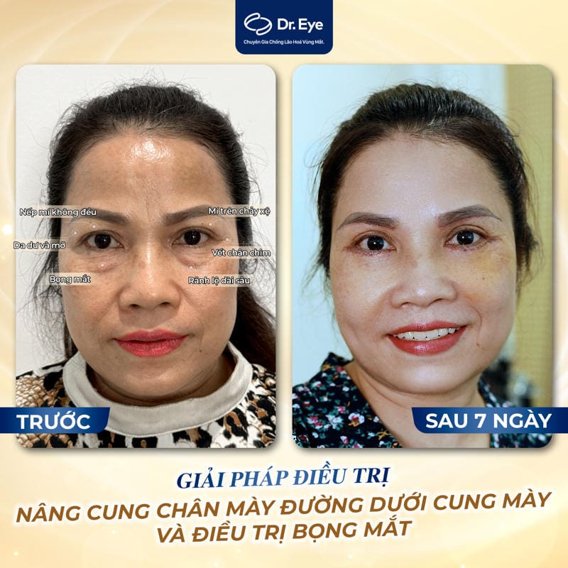 Khách hàng điều trị bọng mắt tại Dr. Eye 2