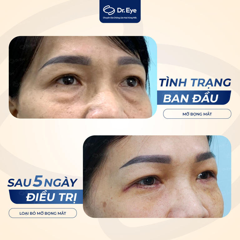 Khách hàng bóc bọng mắt dưới tại Dr. Eye