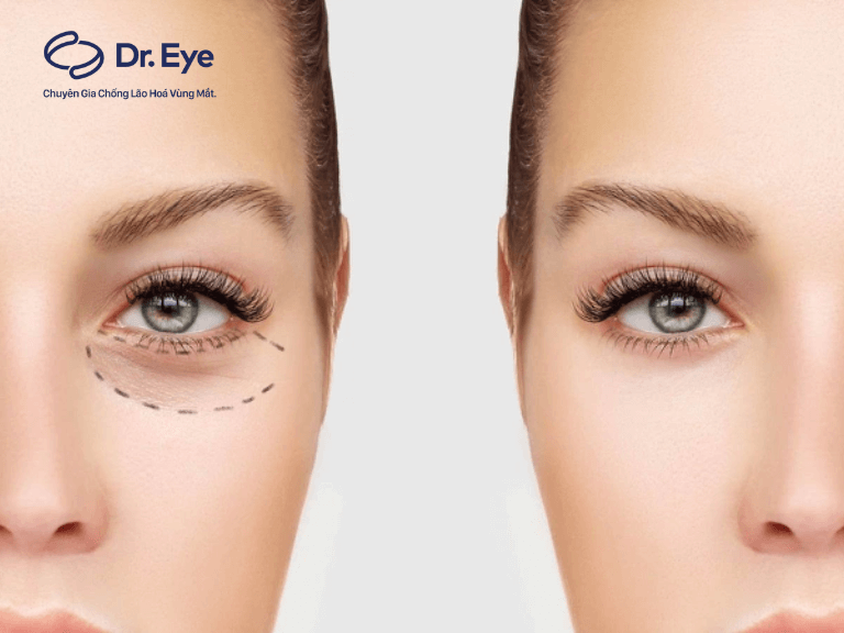 Ai nên cắt bọng mắt dưới