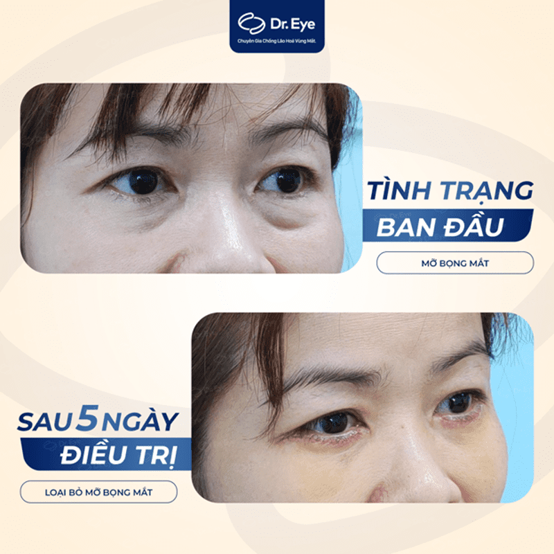 Khách hàng cắt bọng mắt dưới ở Dr. Eye