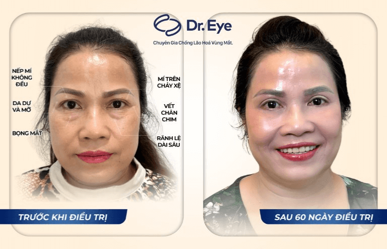 Thẩm mỹ bọng mắt tại Dr. Eye