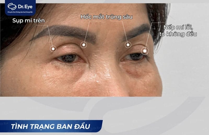 Khách hàng chỉnh sửa cắt mí lỗi tại Dr. Eye