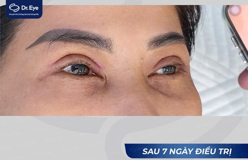 Khách hàng chỉnh sửa cắt mí lỗi tại Dr. Eye sau 7 ngày