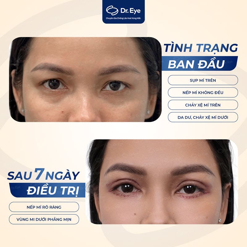 Khách hàng cắt mí tại Dr. Eye