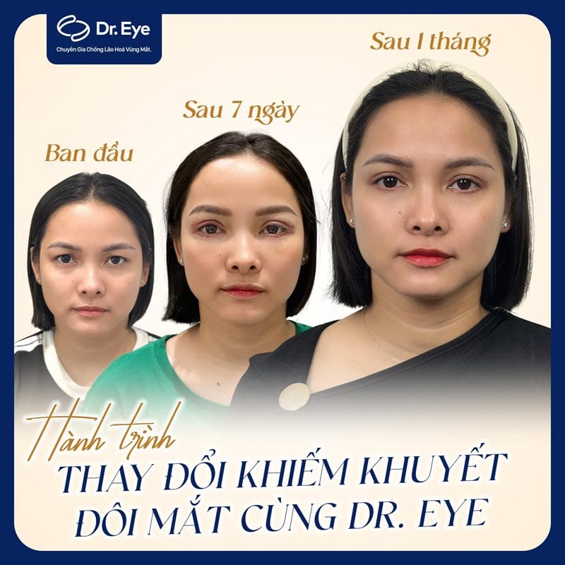 Khách hàng cắt mí tại Dr. Eye 3