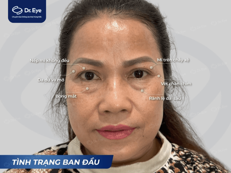 trước khi điều trị bọng mắt