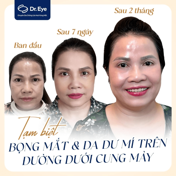 kết quả sau 2 tháng điều trị bọng mắt